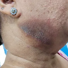 Skin Problem 